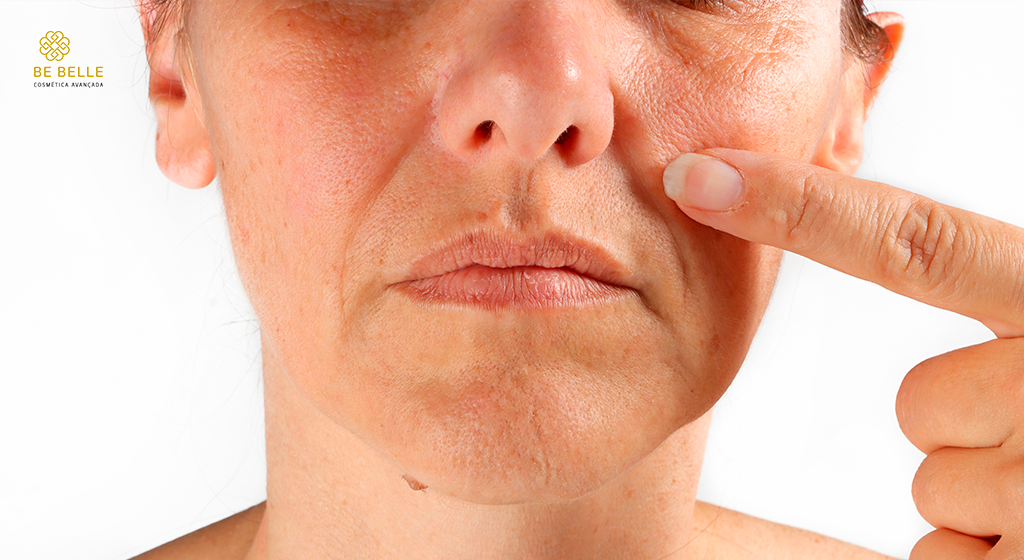 Bigode Chinês: causas, tratamento e os dermocosméticos mais eficazes para suavizar os sulcos nasogenianos