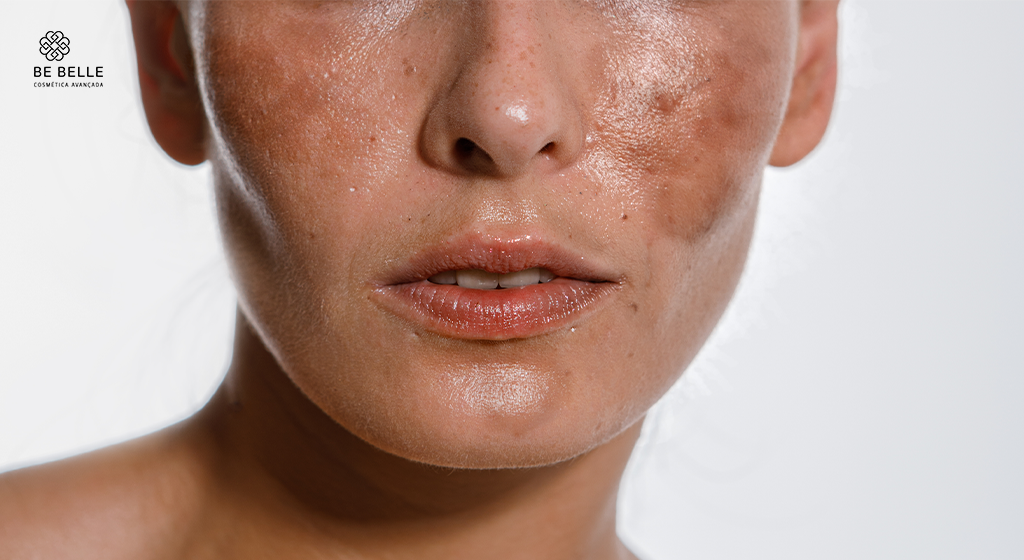 Tenho manchas e pele sensível: como montar uma rotina de skincare sem irritar a pele?