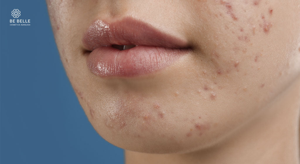 APRENDA QUAIS ATIVOS AUXILIAM NO TRATAMENTO DA ACNE NA PELE - Be Belle Cosmética Avançada