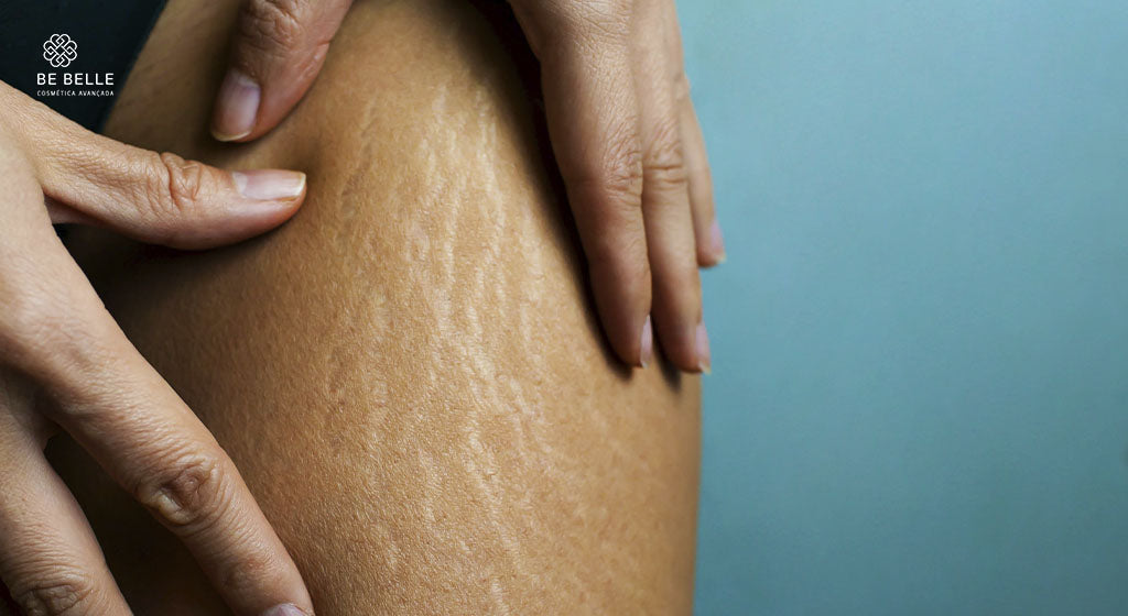 TRATAMENTO DAS ESTRIAS: CONHEÇA QUAIS SÃO OS MELHORES ATIVOS! - Be Belle Cosmética Avançada