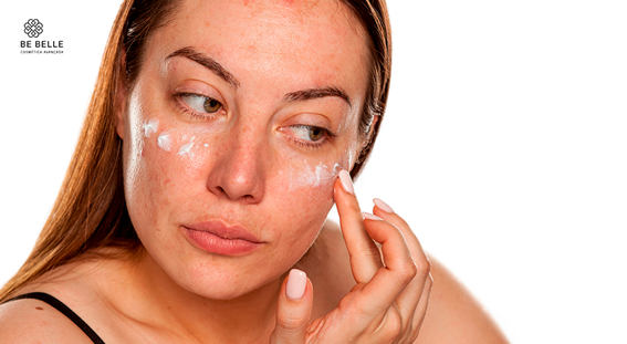 Melasma: Por que só os ácidos não funcionam e como a regeneração da pele é o novo caminho?
