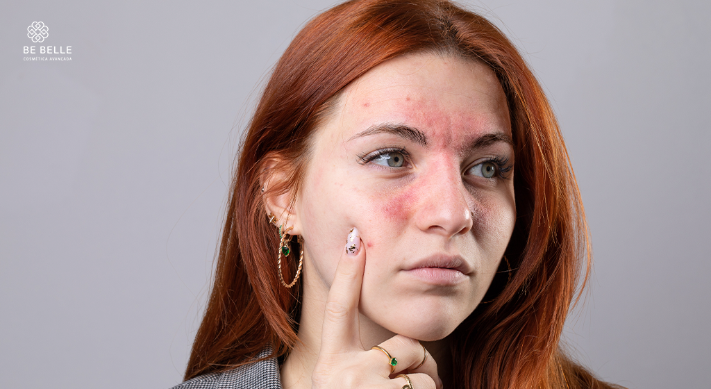 Pele Inflamada: o fator por trás de manchas, acne e envelhecimento precoce; como tratar de forma inteligente